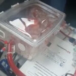 A Bologna primo trapianto a “cuore battente” – video