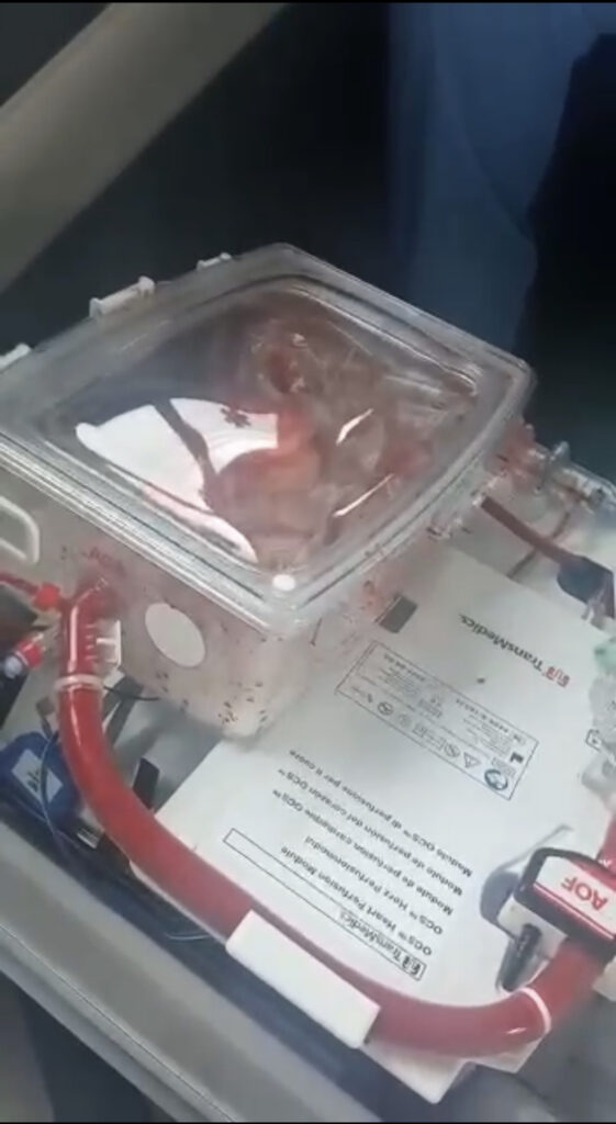 A Bologna primo trapianto a “cuore battente” – video