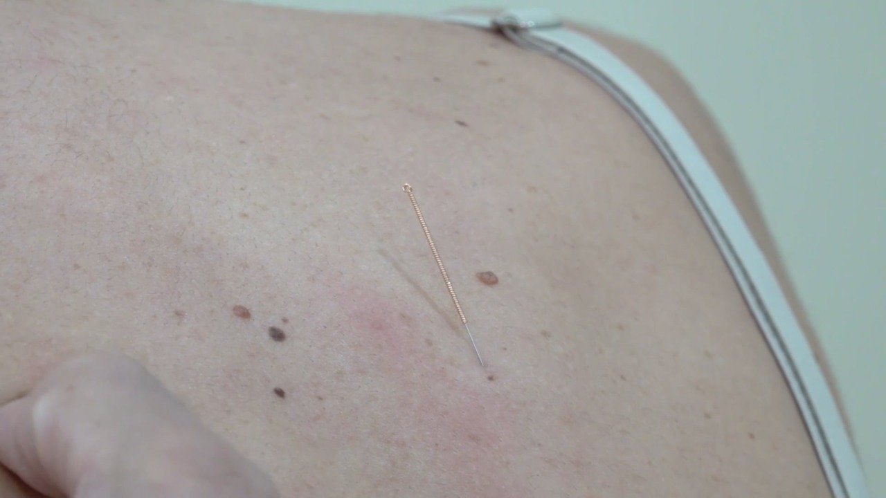 Agopuntura in campo oncologico