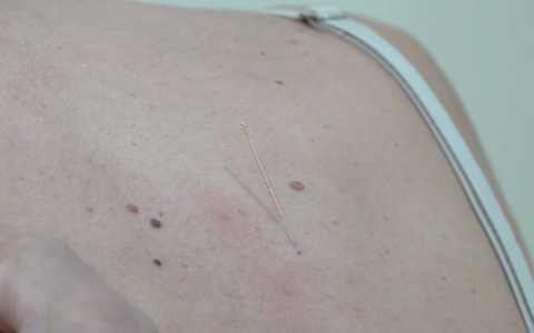 Agopuntura in campo oncologico